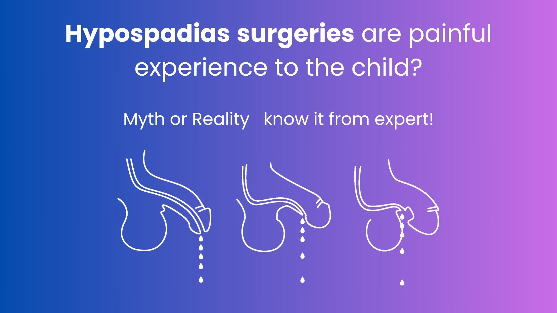 Hypospadias Surgery in Hyderabad – Success Stories by Dr. Prabhu Karunakaran